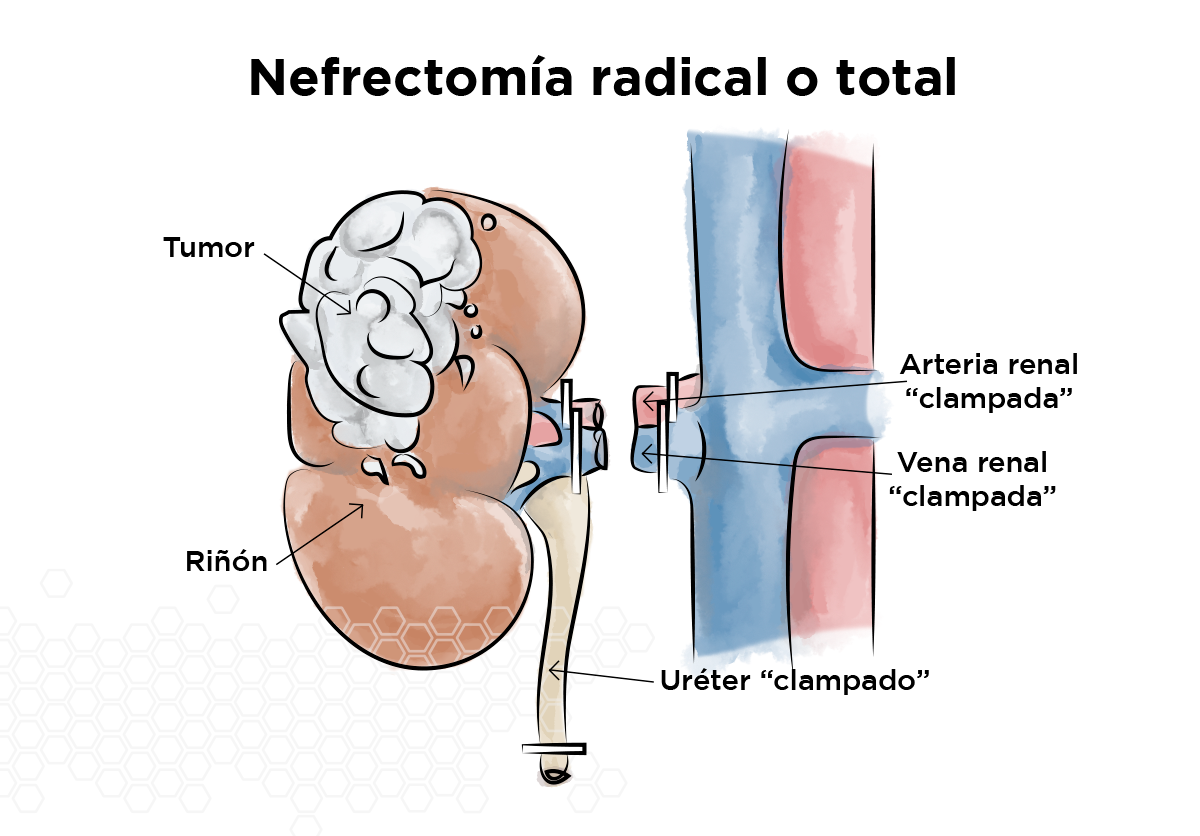 Nefrectom�a radical o total